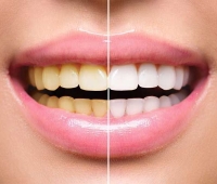 Higienizacja (scaling & piaskowanie) + rozjaśnianie